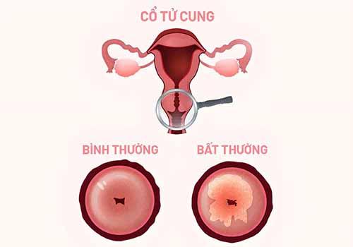 viem-co-tu-cung.jpg