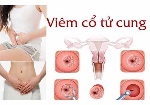viem-co-tu-cung-2.jpg