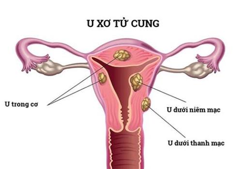 u-xo-tu-cung.jpg