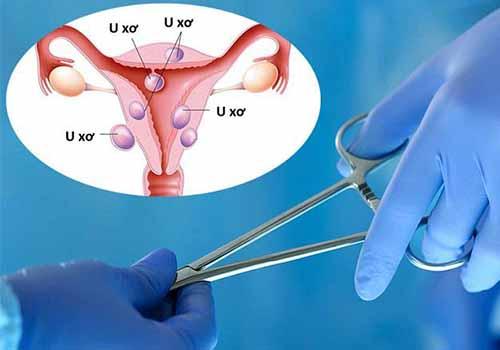 u-xo-tu-cung-3.jpg