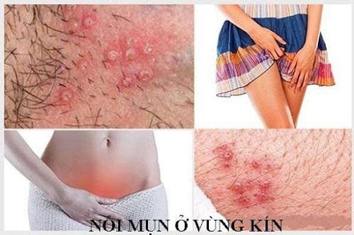 5fa65937ac79575d39f61a4a_noi-mun-o-vung-kin-min.jpg