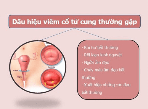 dau-hieu-viem-lo-tuyen-tu-cung.png